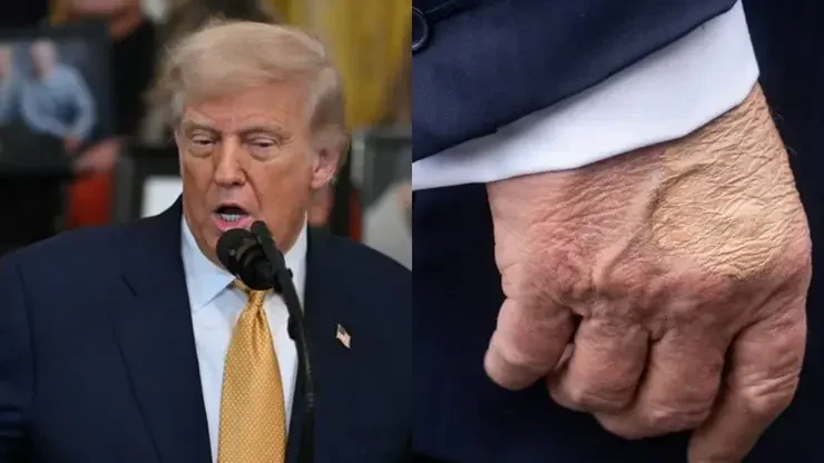 Donald Trump é diagnosticado com insuficiência venosa crônica